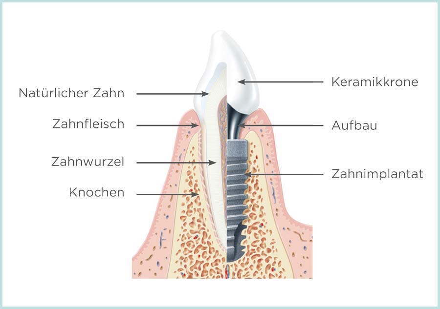 Implantatbehandlung: Vergleich natürlicher Zahn - implantatgetragene Prothese